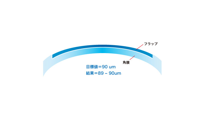 フラップの厚さ フェムトセカンドレーザーの場合 : 約100μm（マイクロメートル）