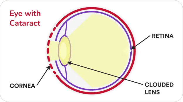 Eye with cataract