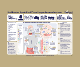 is glutathione bad for hypothyroidism Unlocking the Therapeutic Potential: Selenium and Myo-Inositol Supplementation in Thyroid DisordersEfficacy and Future Directions Hashimoto's thyroiditis and the gut-immune