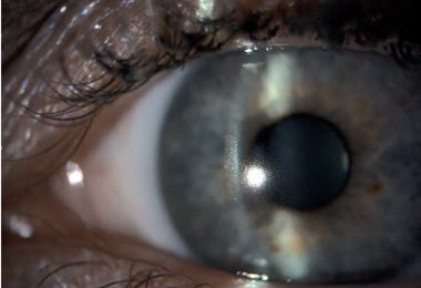 Lär dig mer om essential contact lens practice med denna e-bok. Kvinna som sätter på kontaktlins