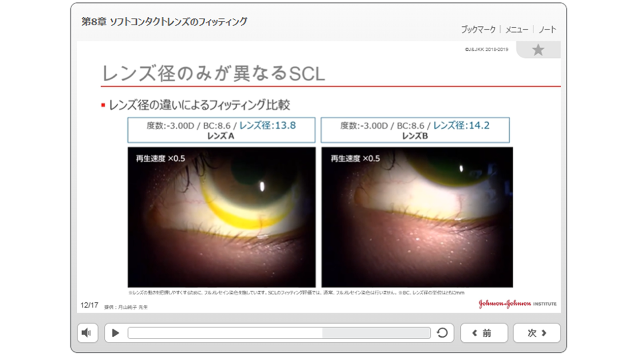 第8章 ソフトコンタクトレンズのフィッティング 第8章 ソフトコンタクトレンズのフィッティング