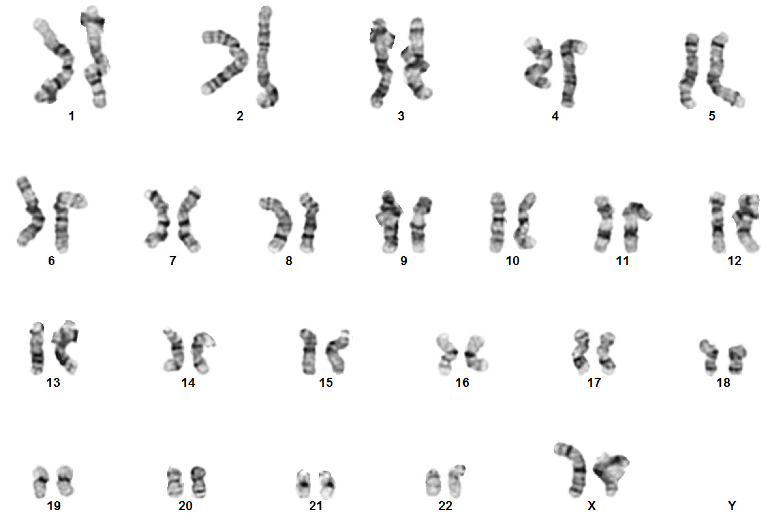 Ring chromosome 13 and ambiguous genitalia. - Abstract - Europe PMC