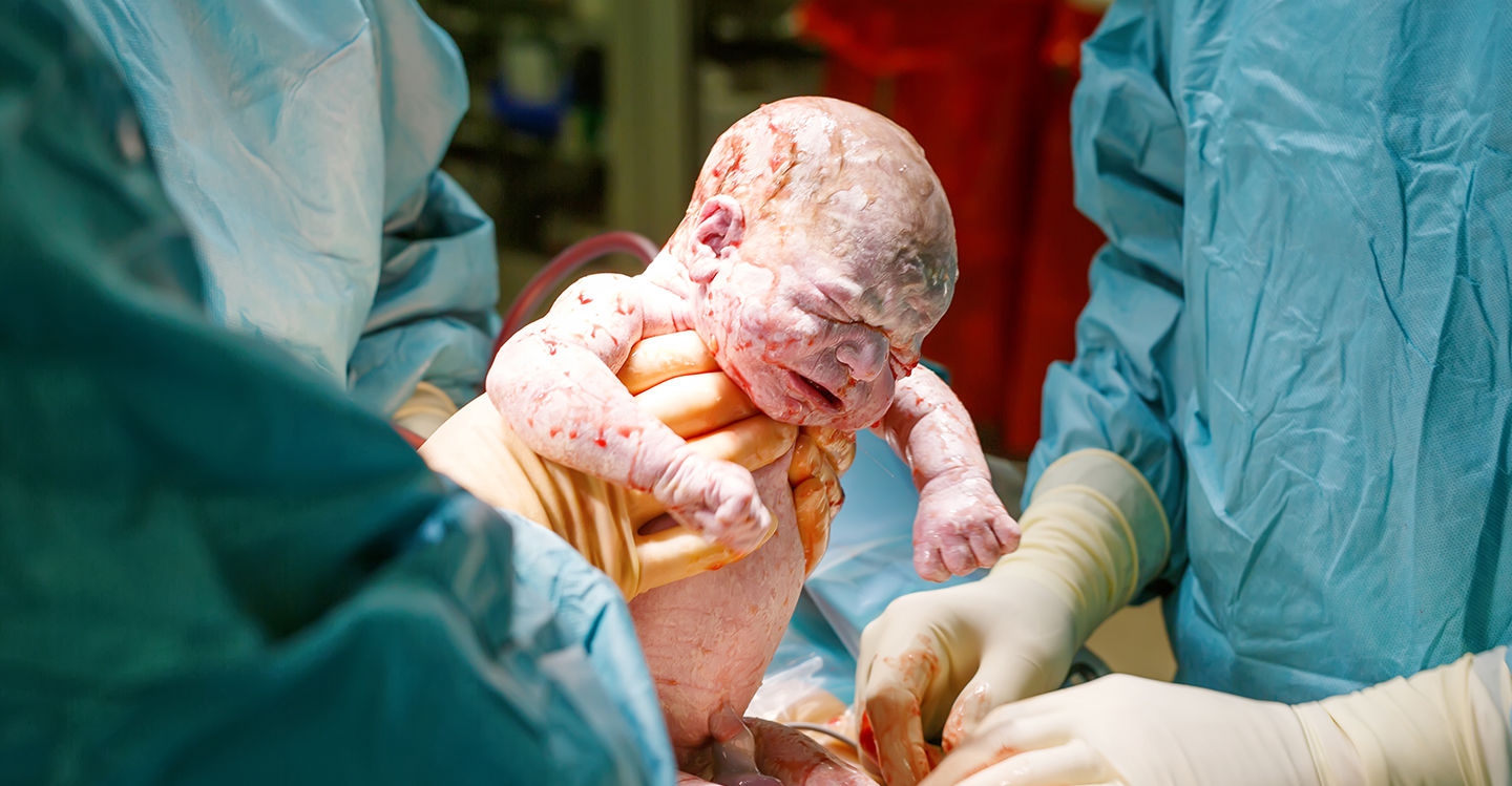 Caesareans, or c-sections: myth vs fact