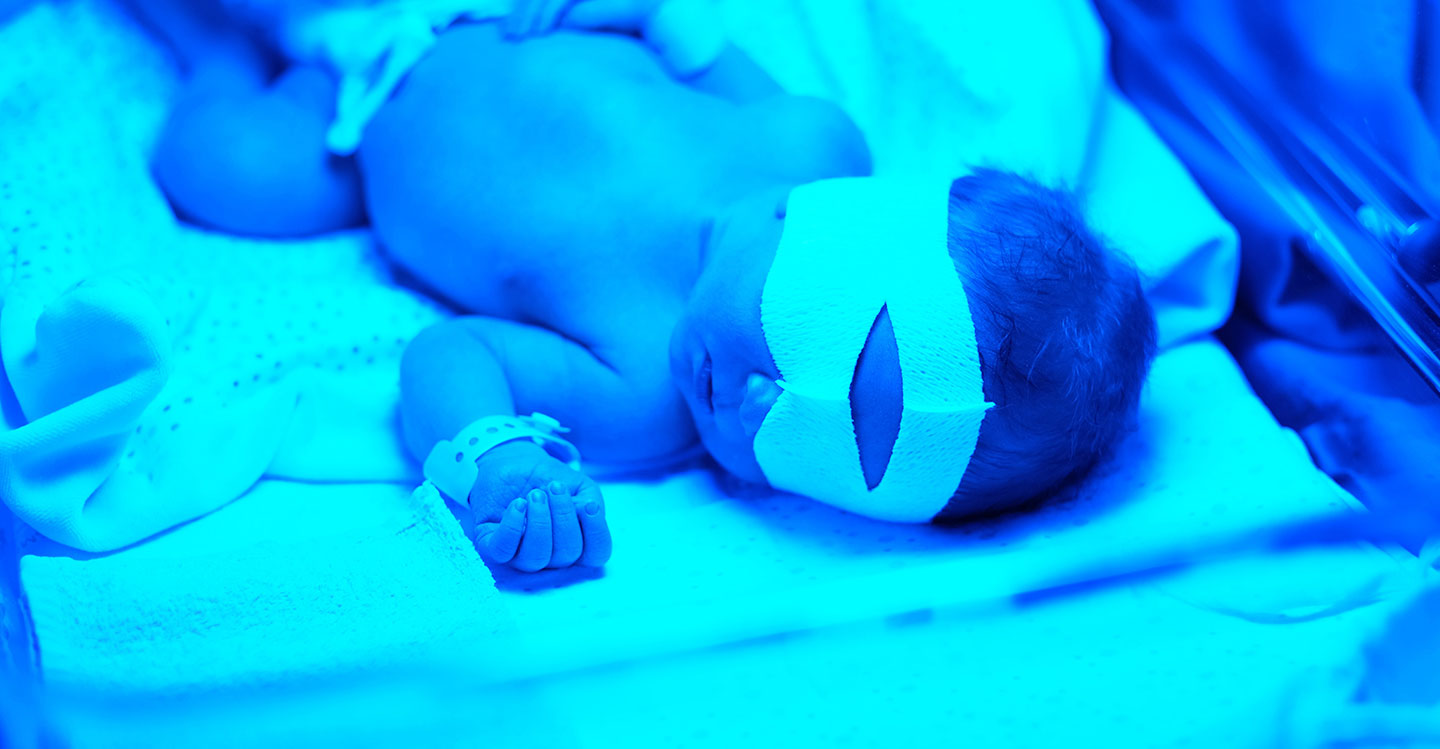 Understanding jaundice in newborns