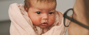 Newborn rashes red marks and dry skin