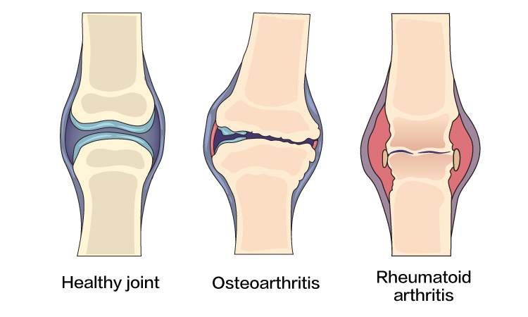 Increased risk of joint-related issues such as osteoarthritis and rheumatoid arthritis_eng.jpg