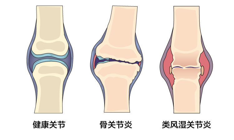 Increased risk of joint-related issues such as osteoarthritis and rheumatoid arthritis_chi.jpg