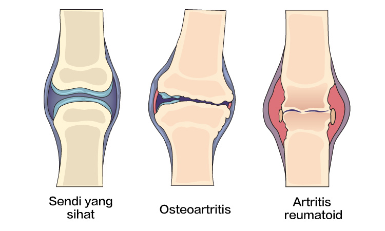 Increased risk of joint-related issues such as osteoarthritis and rheumatoid arthritis_bm.jpg