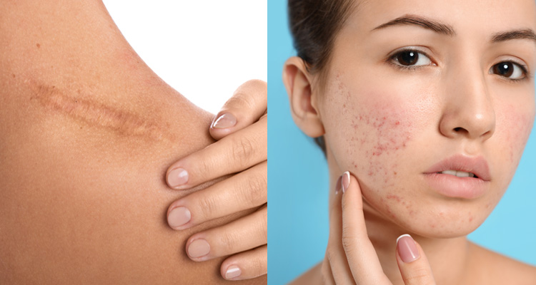 Lecithin E helps overcome skin issues such as scarring and acne.jpg