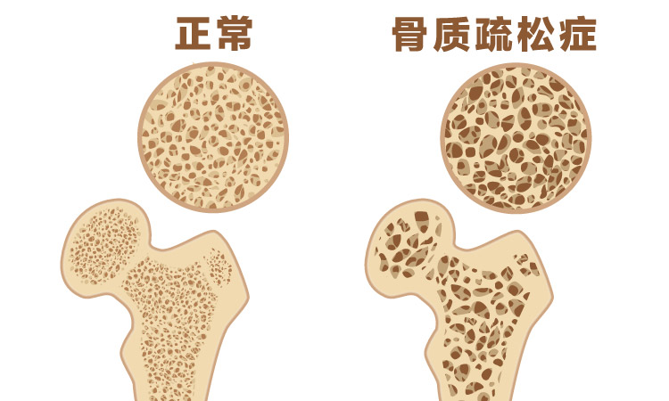 Normal and damaged bone formation_c.jpg