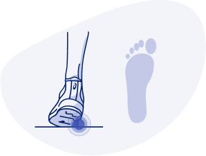 What is Overpronation? Ground Contact: The outside of your heel lands first and your foot rolls inward excessively, putting weight on the inside of your foot. Push-Off: Pressure is focused on your big and second toe. Foot Type: Low arches or flat feet. Potential Injuries: Shin splints, plantar fasciitis, bunions, heel spurs. Recommended Shoes: Shoes with structured support or cushioning.